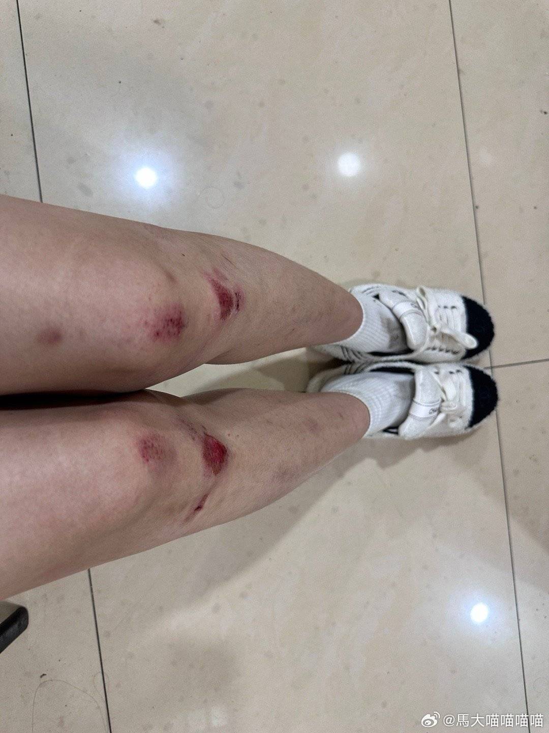 女子晒受伤照怒喷海港外租球员：是人吗？说爱我却伤害我